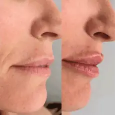 lip-filler-before-after-1