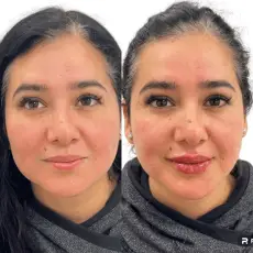lip-filler-before-after-3