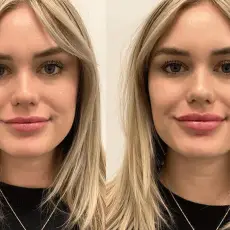 lip-filler-before-after-6