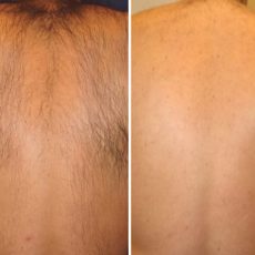 Hair removal 02
